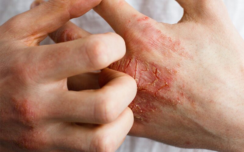 Eczema. Not JustEczema. Not Just Dry Skin. Dry Skin.